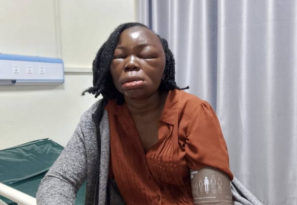 A woman seated in a hospital setting with visible facial swelling, wearing a brown top and a grey sweater, appearing to be receiving medical care.