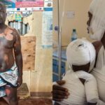A side-by-side image showing a man with visible burn injuries on his chest, abdomen, and legs standing indoors. The second image shows the same man in hospital bandages holding a heavily bandaged toddler, both receiving treatment for severe burn injuries.