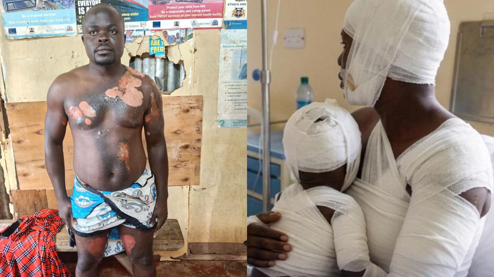 A side-by-side image showing a man with visible burn injuries on his chest, abdomen, and legs standing indoors. The second image shows the same man in hospital bandages holding a heavily bandaged toddler, both receiving treatment for severe burn injuries.